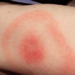 tick-bite-lyme-disease-risk-assessment